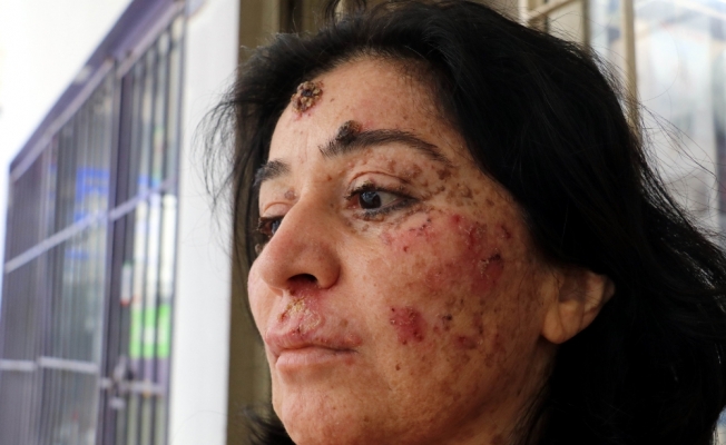 Yüzündeki yaralar hayatı zindan etti: "Deneylere katılmak istiyorum"