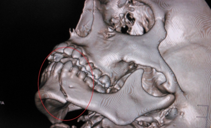 Alt çene kemiği kırıkları