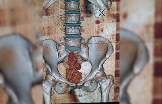 Bağırsaklarındaki uyuşturucu tomografiyle ortaya...